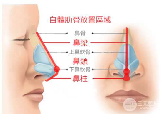 软骨隆鼻手术多少钱
