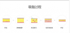腰部吸脂手术以后痛么？术后疼痛期是多久？