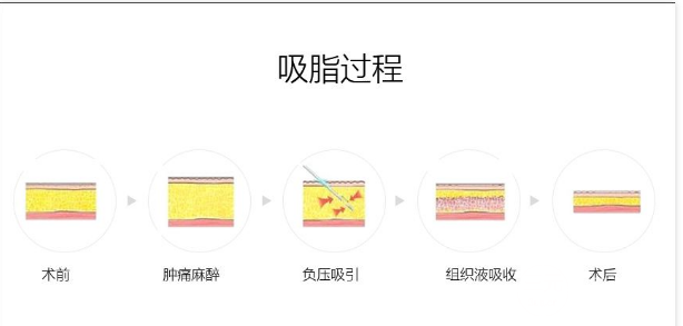 腰部吸脂手术以后痛么?术后疼痛期是多久?