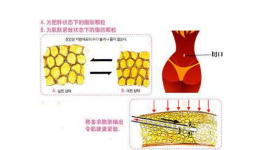 腰部吸脂手术以后痛么?术后疼痛期是多久?