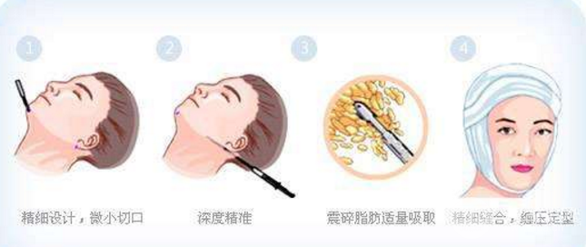 面部吸脂是小手术吗？别掉以轻心哟！