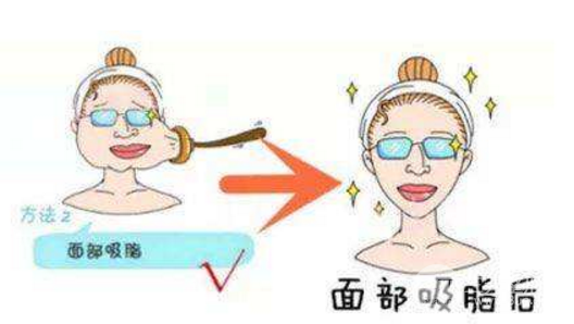 面部吸脂是小手术吗？别掉以轻心哟！