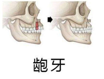 龅牙矫正要多少钱