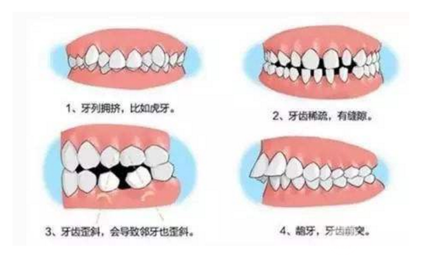 龅牙矫正要多少钱
