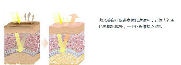 激光全身美白多少钱