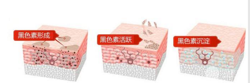 激光全身美白多少钱