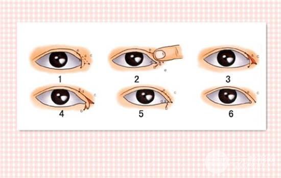 10个开内眼角9个留疤？选择医生+术后护理很重要！