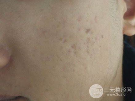 反复的痘疤怎么去