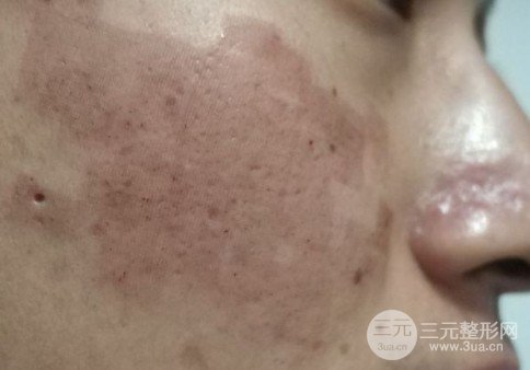 反复的痘疤怎么去