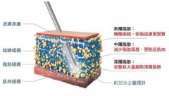 专家说|威塑吸脂原理及【果图】,有哪些优势?
