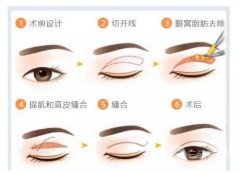 拉双眼皮的方法大公开，别人都在用哪种?