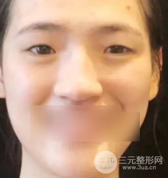 上海华美双眼皮案例