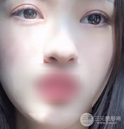 上海华美双眼皮案例