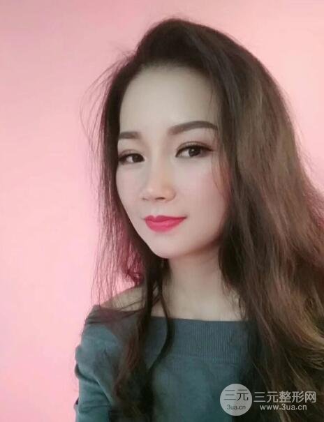 隆鼻案例：