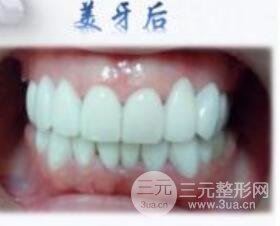 牙齿美白案例：