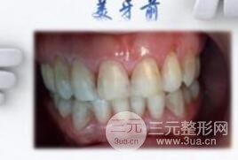 牙齿美白案例：