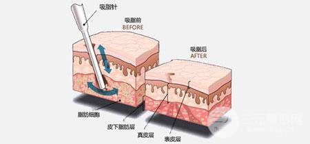 手臂瘦手臂吸脂手术价格贵吗？大概多少钱？