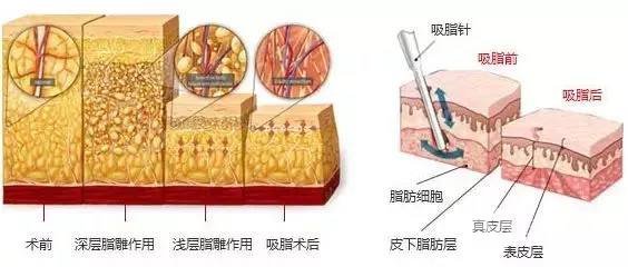 小腿吸脂果