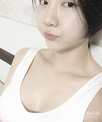 水滴隆胸350cc效果图 美胸日记分享