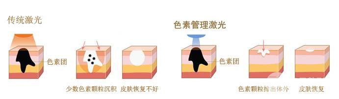 激光能去黄褐斑吗
