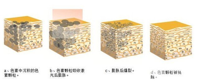 激光能去黄褐斑吗