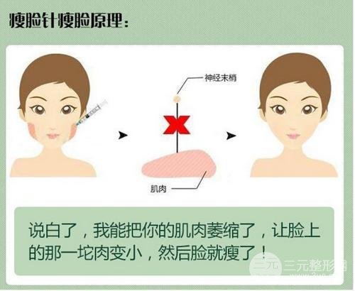 注射注射瘦脸多少钱