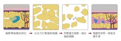 沈阳做吸脂手术多少钱啊？有推荐的医院吗？