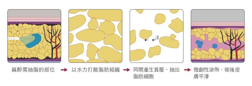 沈阳做吸脂手术多少钱啊？有推荐的医院吗？
