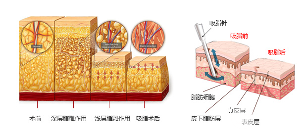 沈阳做吸脂手术多少钱啊？有推荐的医院吗？