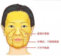 圆脸怎么变瓜子脸？面部吸脂帮你！