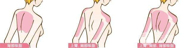虎背熊腰,背部吸脂手术让你轻松拥有性感美背!