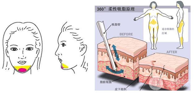 小腿吸脂手术反弹的概率大不大?