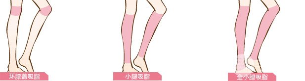 小腿吸脂手术反弹的概率大不大?