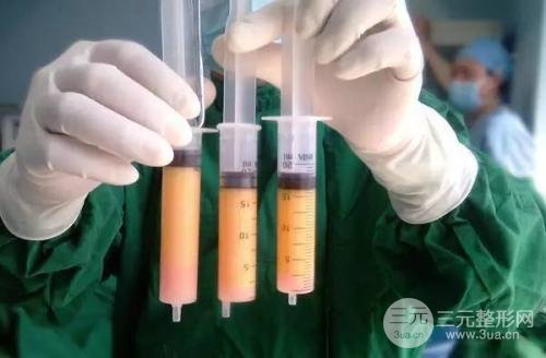 小腿吸脂手术反弹的概率大不大?
