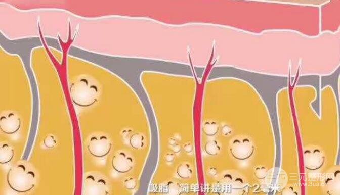 全身吸脂手术果怎么样?轻微肥胖适合做吗?