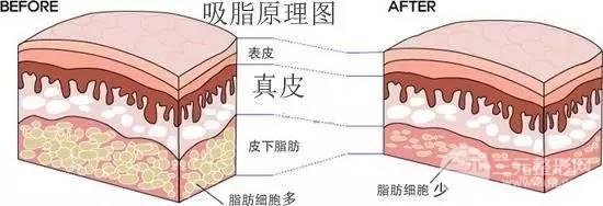 全身吸脂手术果怎么样?轻微肥胖适合做吗?
