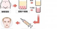 背部吸脂手术价格是怎么算的？贵不贵？