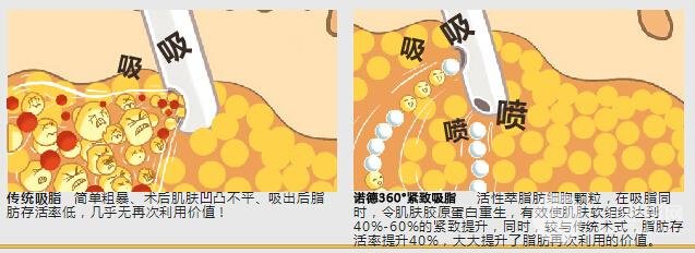 背部吸脂手术价格是怎么算的?贵不贵?