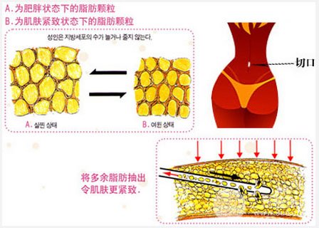 背部吸脂手术价格是怎么算的?贵不贵?