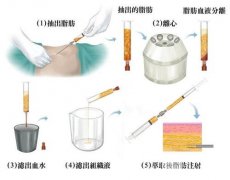 做腹部环吸脂手术准备工作 术前注意事项