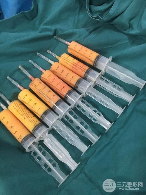 做腹部环吸脂手术准备工作 术前注意事项