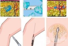 小腿吸脂手术副作用 风险 后遗症讲解，做不做看自己了~