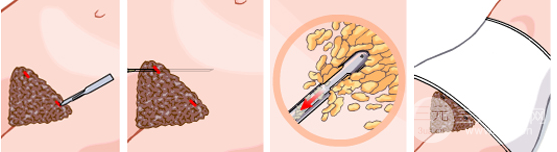 腰部吸脂是外科手术吗?手术创伤大不大?