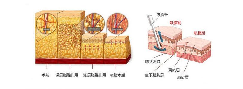 腰部吸脂是外科手术吗?手术创伤大不大?