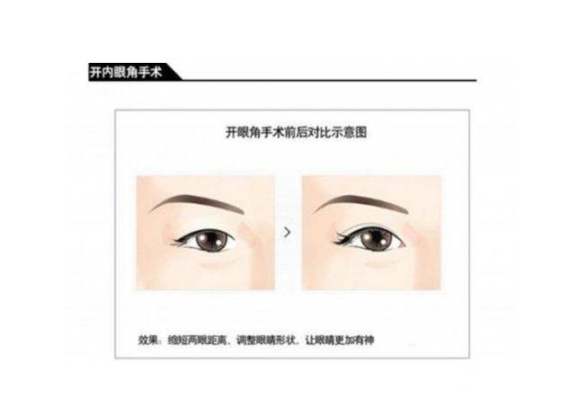 开眼角对比图2