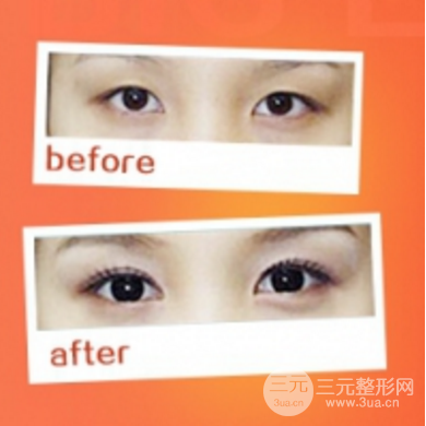 开眼角对比图
