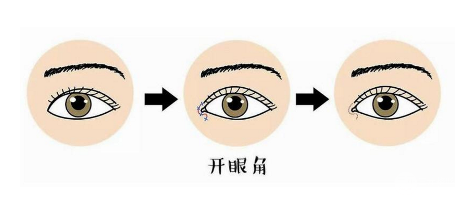 开眼角对比图2