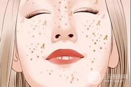 激光去黄褐斑多少钱
