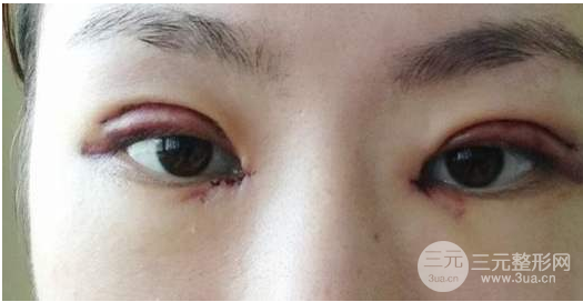 全切双眼皮价格
