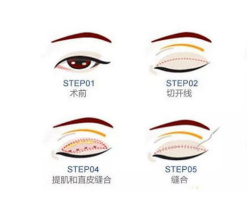 割双眼皮开眼角